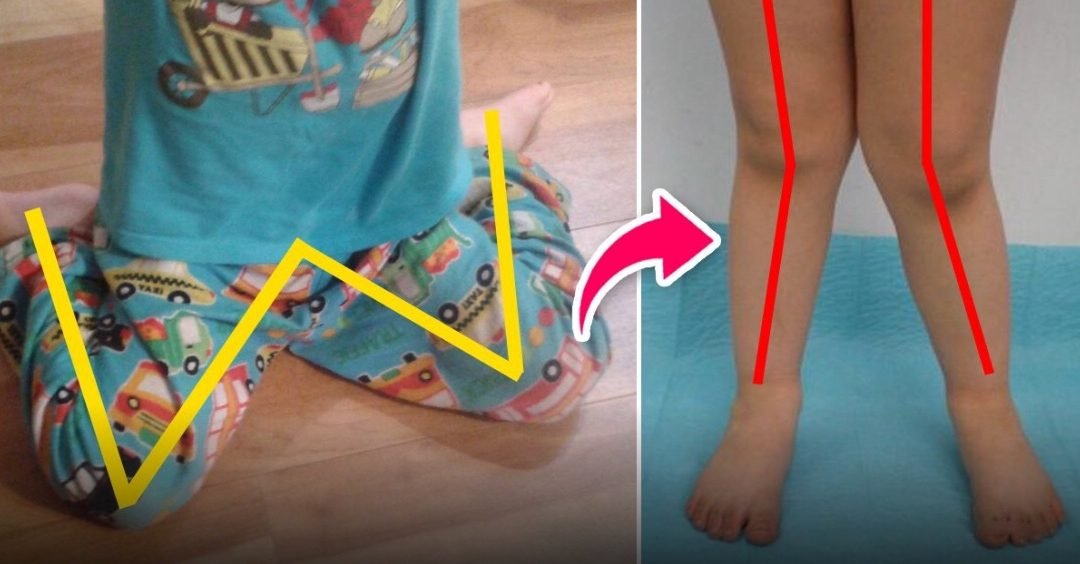 “W” sitting position can be bad for children. Try to correct it before it’s too late